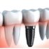 Dental Repairs vs Extraction And Dental Implants